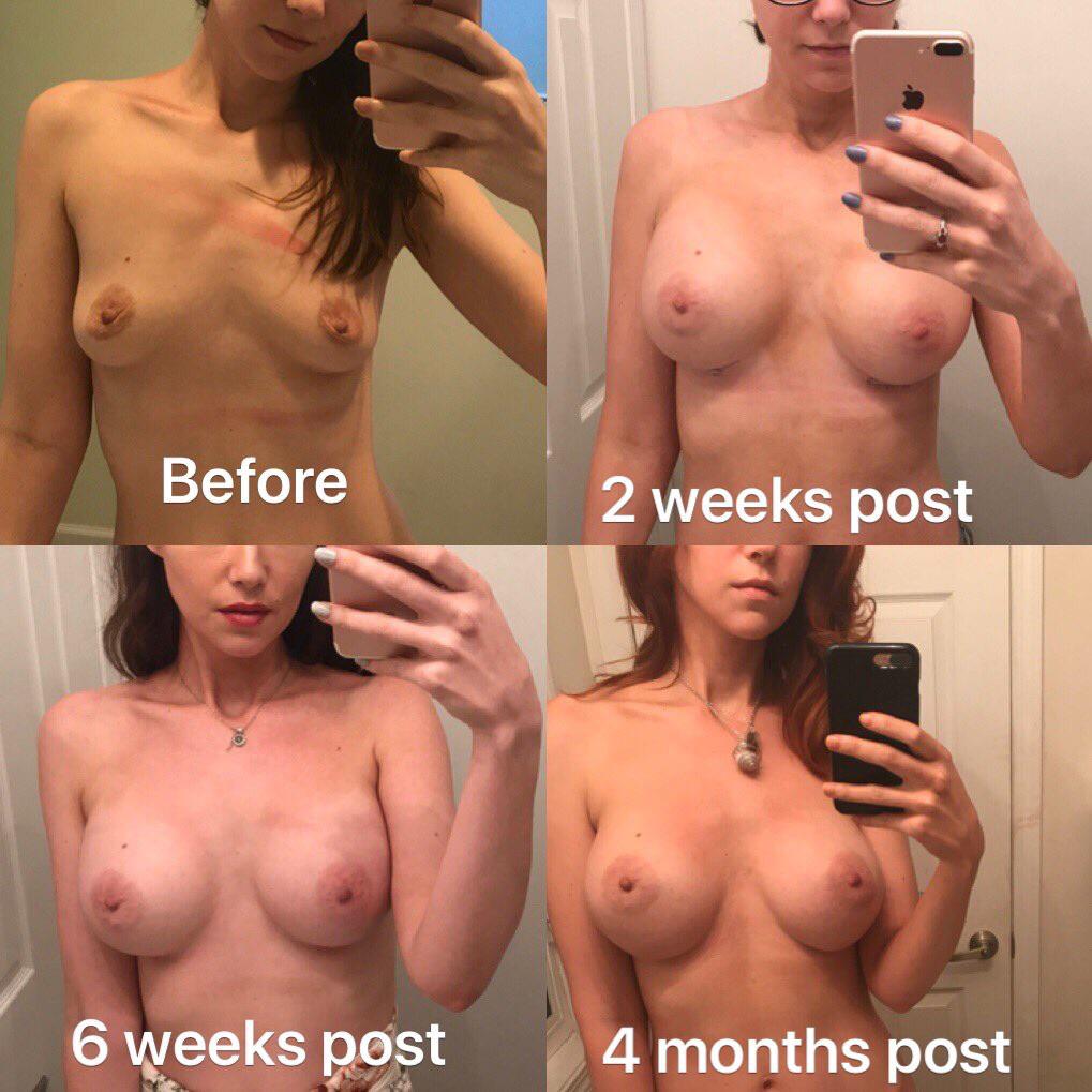Here’s Kat’s boob evolution.