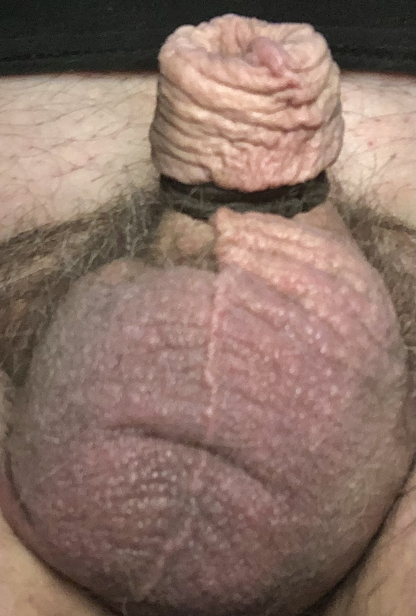 Micropenis missing Gland