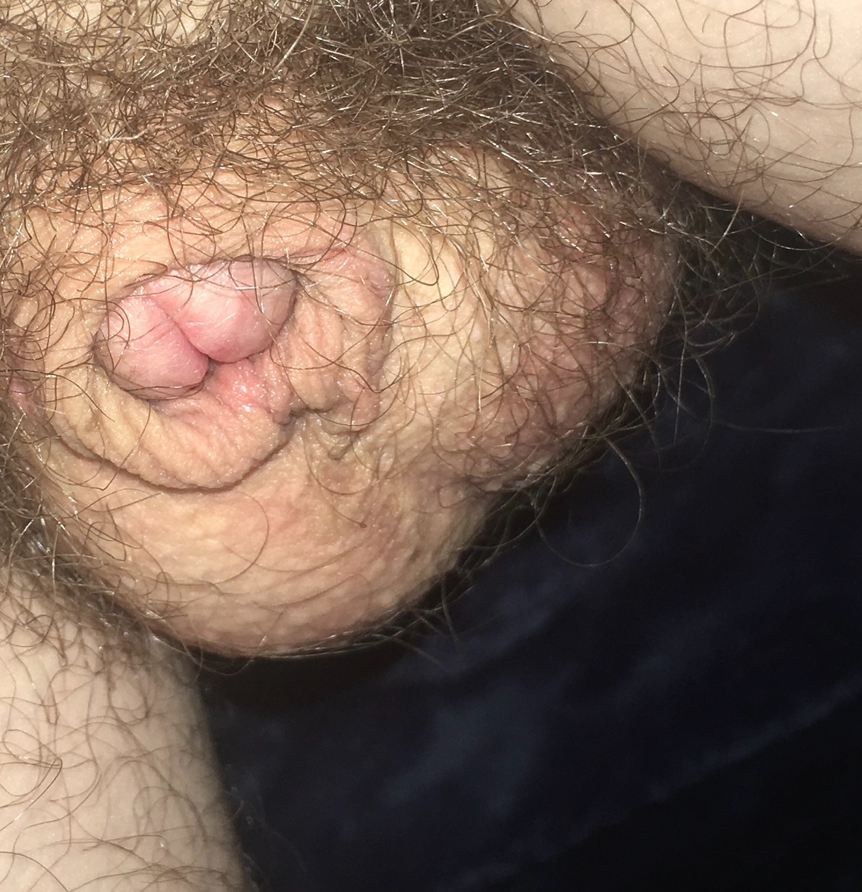 Shrunken clit numb and impotent 